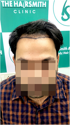 Before Hair Transplant HS 827- The Hairsmith Clinic Delhi India - 1