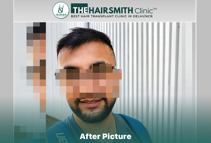 6 months hairsmith hair transplant result - the hairsmith clinic delhi #hairtransplant
