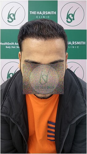 After Hair Transplant Result -04 Months Update - The Hairsmith Clinic (2)