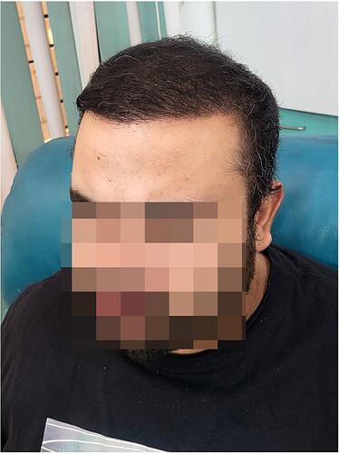 After Hair Transplant Result - The Hairsmith Clinic Delhi India (3)
