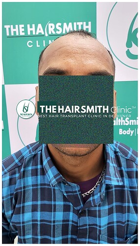 Before Hair Transplant Picture 1 - The Hairsmith Clinic