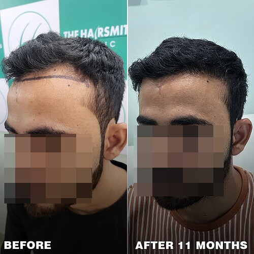 best hair transplant result  after 11 months at the hairsmith clinic - (2)