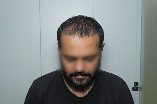 after 3 month result