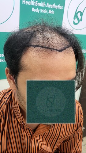 Patient Norwood stages 7 - Before  Picture 3 - The Hairsmith Hair Transplant Clinic