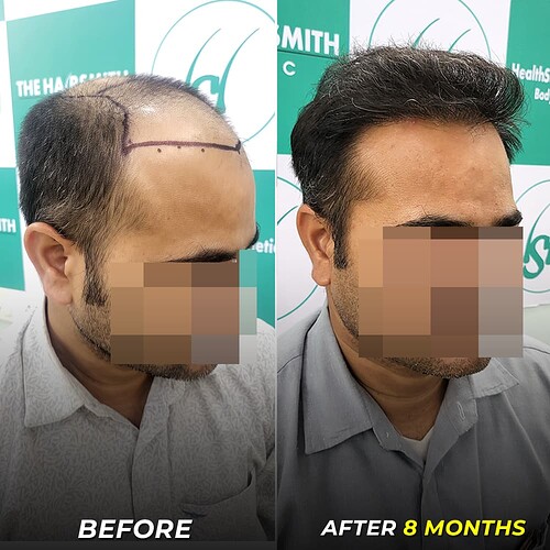 best hair transplant after 8 months at the hairsmith clinic - 2