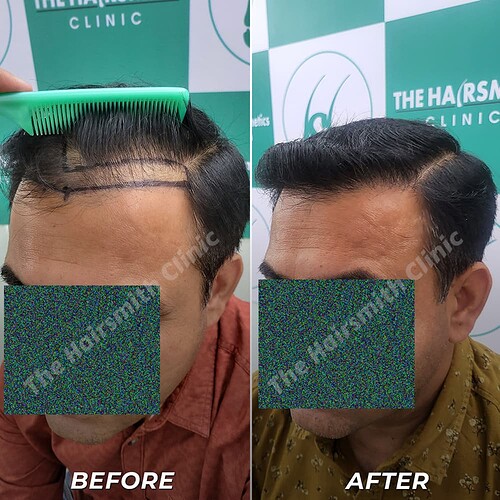 Best Hair Transplant Result - After 10 Months Update - The Hairsmith Clinic Delhi India - 4