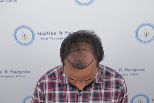 hair line marking