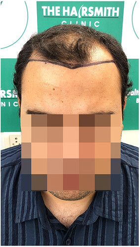 Before Hair Transplant HS 819- The Hairsmith Clinic Delhi India - (1)