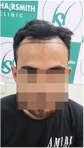 Before Hair Transplant HS 815 - The Hairsmith Clinic Delhi India - (1)