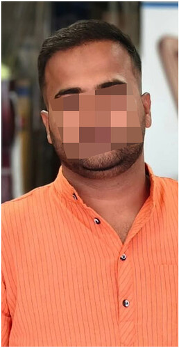 the hairsmith clinic - 02 years hair transplant result update