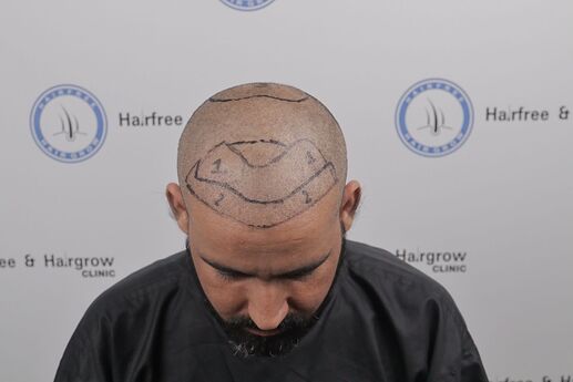hair line marking