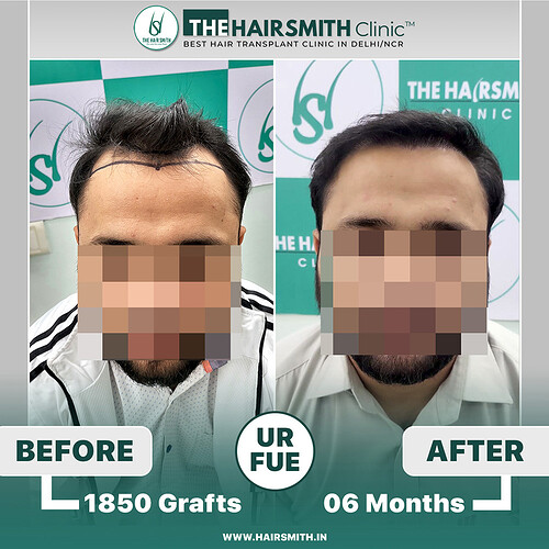 the hairsmith hair transplant result - 06 months update - 1