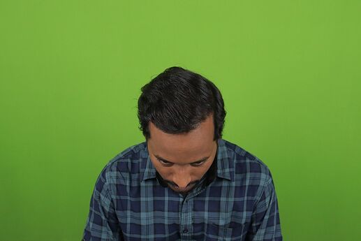 after 8 month hair transplant result