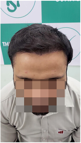 06 months hair transplant result - the hairsmith clinic delhi ncr india - 3