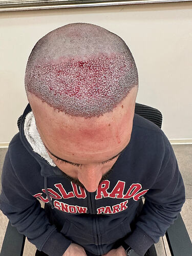 4. Post op 3460 grafts top