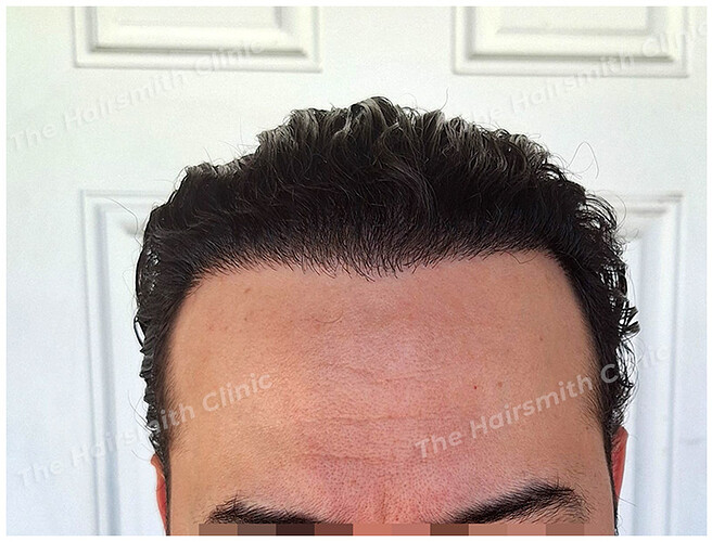 After Hair Transplant Result from The Hairsmith Clinic Delhi India - 1
