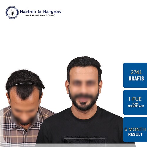 hair-transplant-2741-grafts-6-month-result-pune.jpg (1)