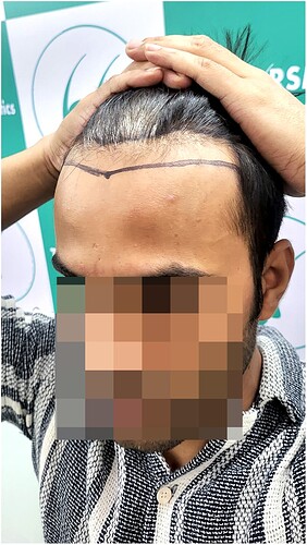 Before Hair Transplant HS823- The Hairsmith Clinic Delhi India (d)