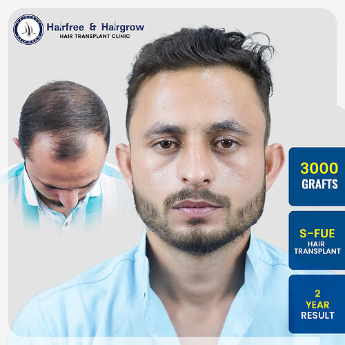 jeevan-sharma-3000-grafts-s-fue-2-year-result-pune.jpg
