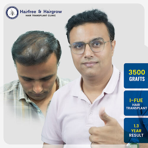 chetan-waghamare-hair-transplant-result-india-3500-grafts-i-fue-1.3-year.jpg
