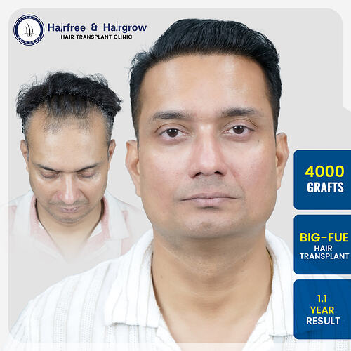 shrikant-kale-hair-transplant-result-pune-india-4000-grafts-big-fue.jpg