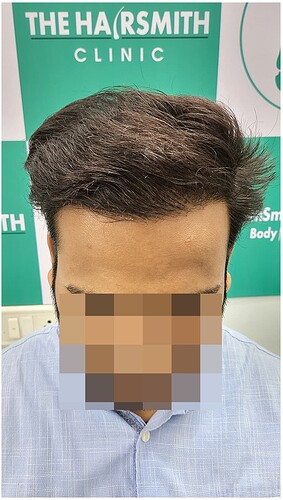 After Hair Transplant Result - The Hairsmith Clinic (2)