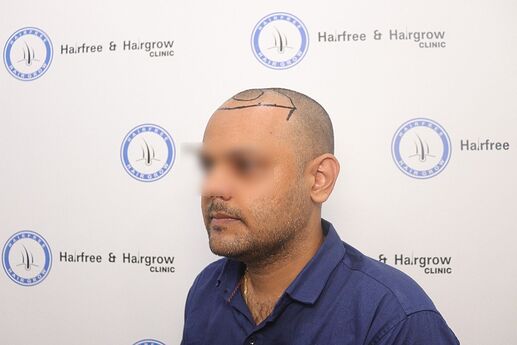 side view before transplant