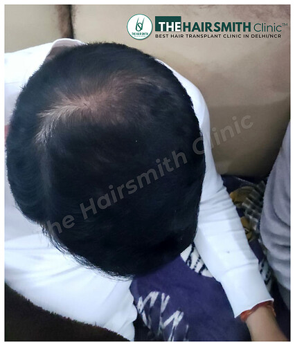 Hair Transplant Result - After 09 Months Update - The Hairsmith Clinic 2