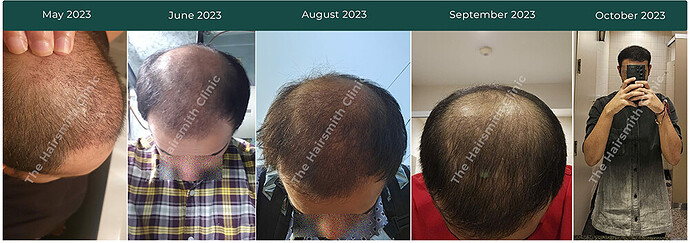 Patient Hair Transplant Journey 2023 - The Hairsmith Hair Transplant Clinic