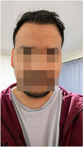 After 09 months hair transplant result update - the hairsmith clinic