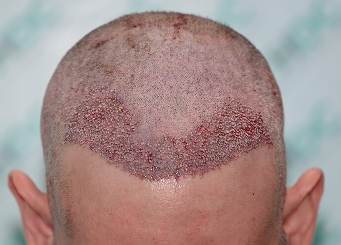 2. Hairline post op