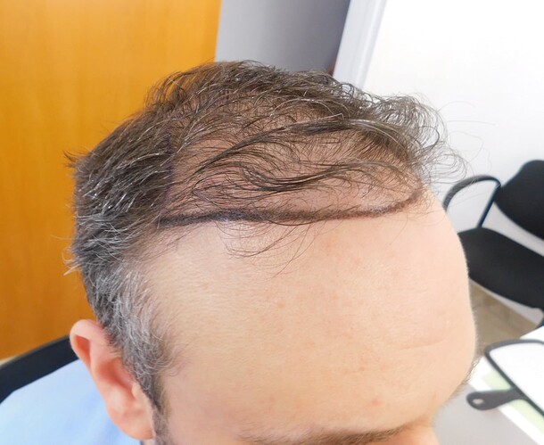 thumbnail_1. Before - right