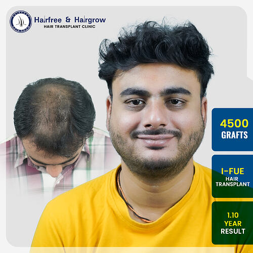 onkar-gawande-4500-grafts-i-fue-hair-transplant-result-pune.jpg
