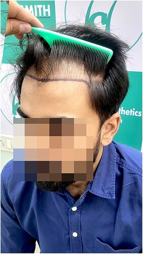 Before Hair Transplant HS 826- The Hairsmith Clinic Delhi India - 3