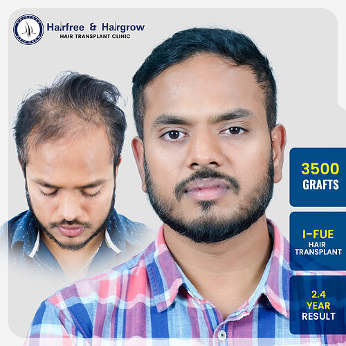 3500-grafts-i-fue-hair-transplant-2-4-year-result-mangirish-kavlekar-pune.jpg