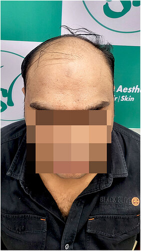 Before Hair Transplant HS 824- The Hairsmith Clinic Delhi India (2)