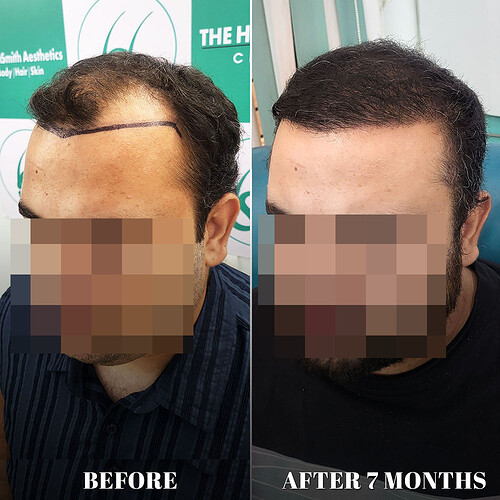 After 07 months hair transplant result update at the hairsmith clinic delhi india (2)