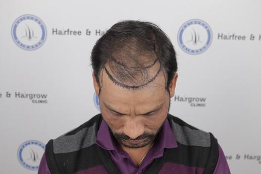 hair line marking