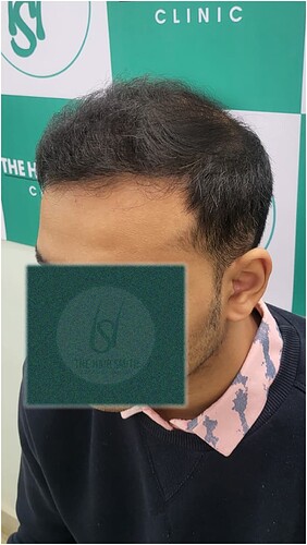 After Hair Transplant Result (4)  in India form The Hairsmith Clinic