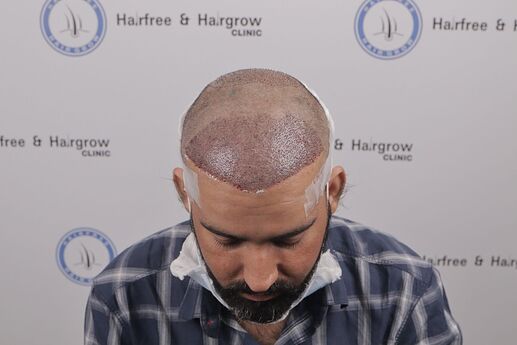 after immediate hair transplant