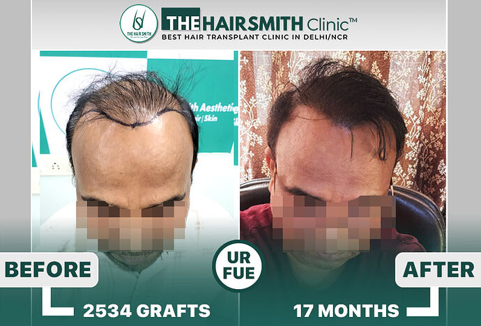 best hair transplant results in india - the hairsmith clinic