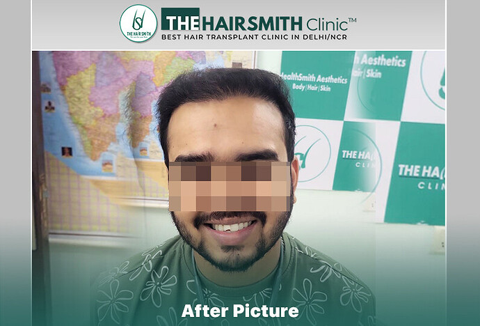 after hair transplant result - the hairsmith clinic delhi india #HairTransplant #URFUEHairTransplant