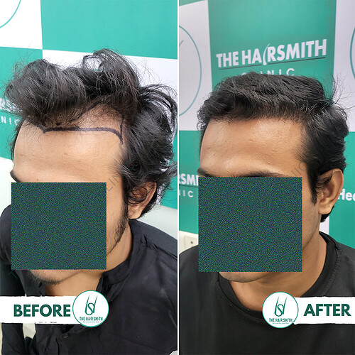 Hairline Hair Transplant Result After 6 months update - The Hairsmith Hair Transplant Clinic 3.PNG