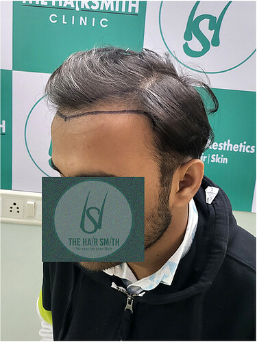 Patient Norwood stages 3 - Before  Picture (4) - The Hairsmith Hair Transplant Clinic