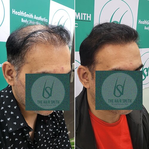 Best Hair Transplant Result Picture 4 - The Hairsmith Hair Transplant Clinic