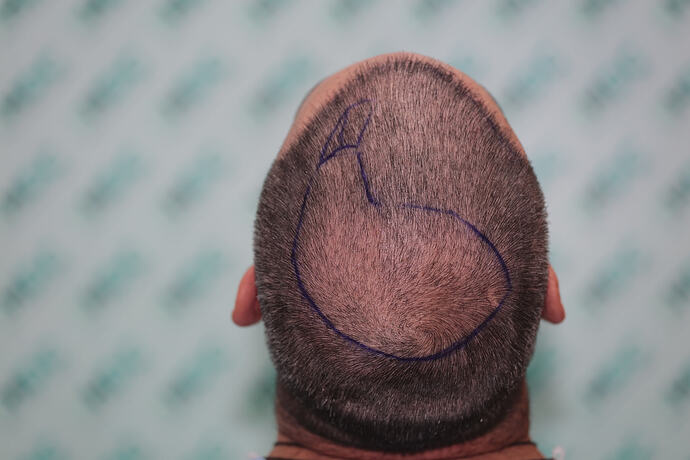 5. Crown before FUE2 with Design