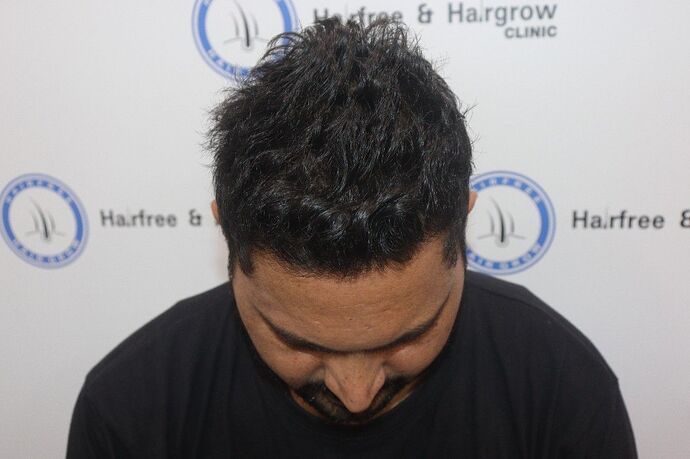 hair transplant before after
