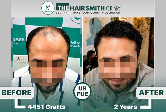 24 months hairsmith hair transplant result - The Hairsmith Clinic - #HairTransplant #The HairmsithClinic