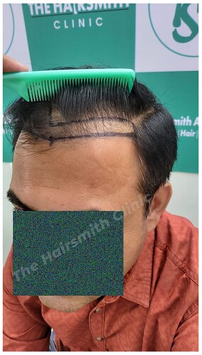 Before Hair Transplant Picture - The Hairsmith Clinic C