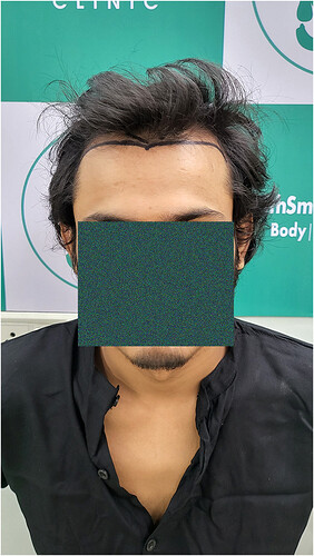Patient Norwood stages 2 - Before  Picture 1 - The Hairsmith Hair Transplant Clinic